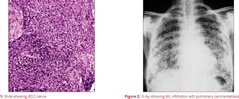 Figure 1 From Pulmonary Lymphangitic Carcinomatosis From Squamous Cell Carcinoma Of The Cervix A