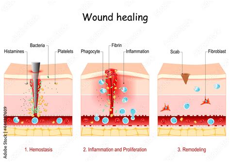 wound healing. Stages of the post-trauma repairing process Stock Vector | Adobe Stock