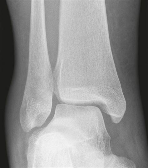 X Enkel Startradiology Radiology Imaging Ankle Fracture Avascular