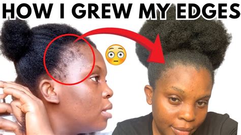 Omg It Works Regrow Your Edges And Baldspots Home Remedy Youtube