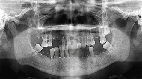 Perda Ssea Alveolar De S Moreira Clinic