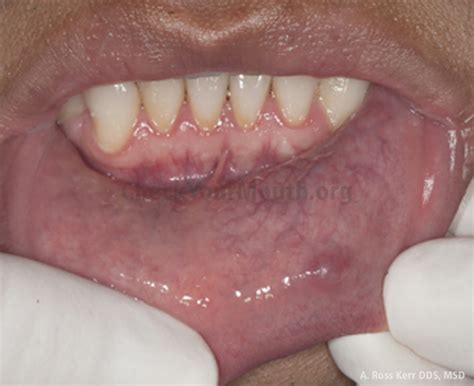 Floor Of Mouth Swollen On One Side Review Home Co