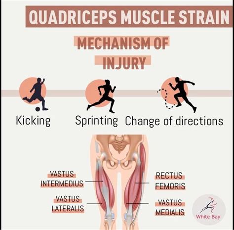 Quadriceps Strains Quadriceps Strain Muscle Strain Muscle Tear