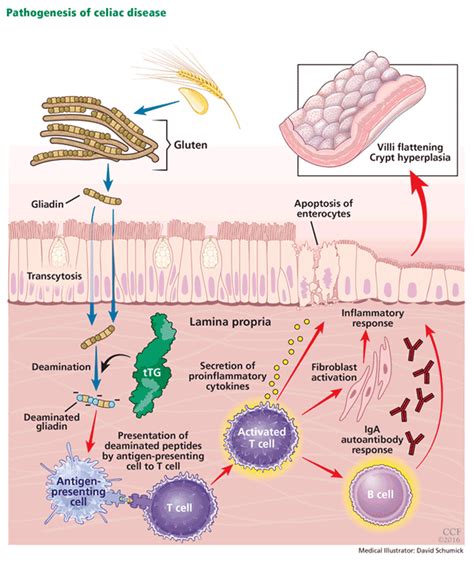 Celiac Disease Managing A Multisystem Disorder Cleveland Clinic