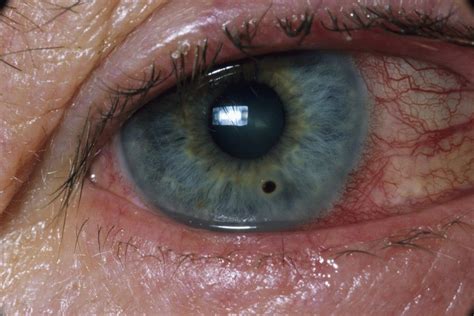 Foreign Body In Eye