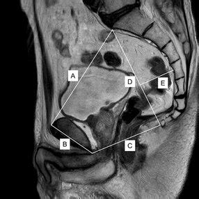 Pelvic Measurements Illustrated On A Sagittal Magnetic Resonance Image