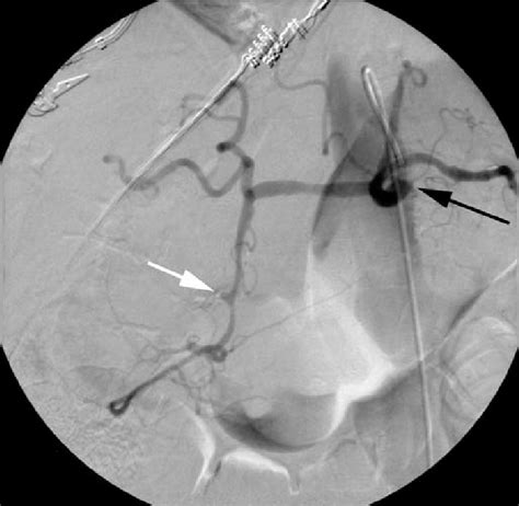 Celiac Artery Injection Black Arrow Shows The Gda With Pseudoaneurysm Download Scientific