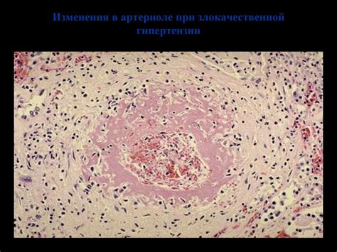 Артериальная гипертензия - презентация онлайн