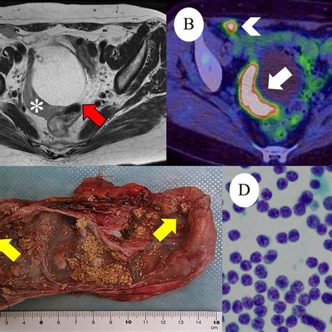 A Axial T2 Weighted Magnetic Resonance Image Reveals A 70 Mm Right