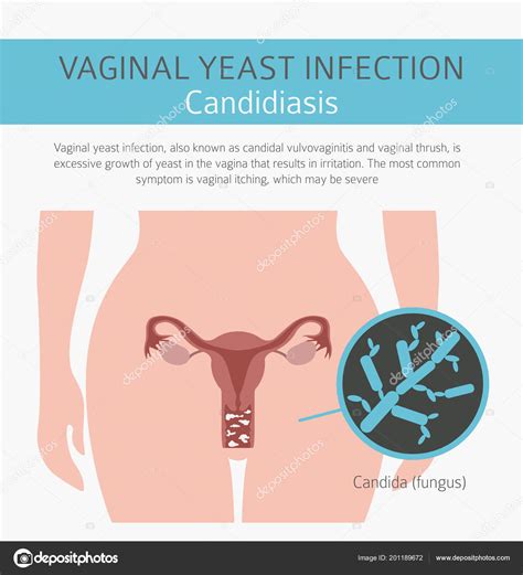 Infecci N Vaginal Por Levaduras Candidiasis Infograf A Ginecol Gica