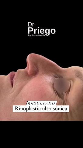 Rinoplastia Ultras Nica En Barcelona Cl Nicas Barnamedik