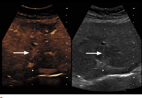 Figure 2 From Benefits Of Contrast Enhanced Ultrasonography For