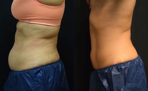 Body Contouring With Coolsculpting Before And After Dr Jeffrey Wise