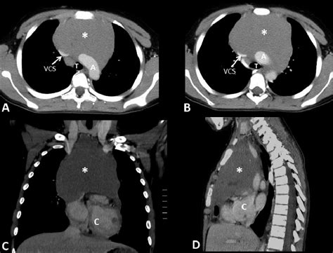 Tomografía computada de tórax con contraste endovenoso en cortes