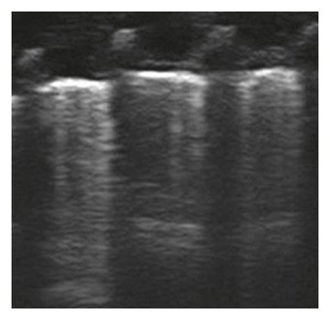 Four Ultrasound Aeration Patterns A Normal Aeration N The