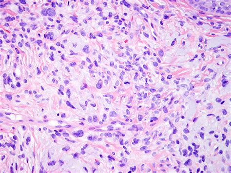 Atypical Fibroxanthoma Dermatopathology