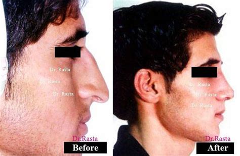 Persian Nose Jobs 2 Rhinoplasty Cost Pics Reviews Qanda