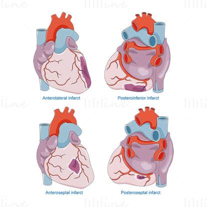 Remodelación del ventrículo izquierdo después de un infarto de