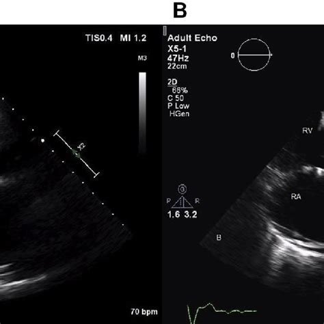 A B Transthoracic Echocardiography In The Parasternal Long Axis And