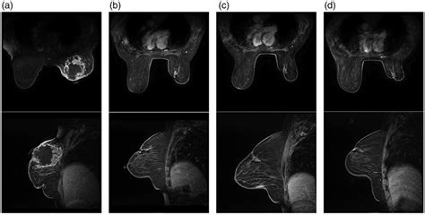 Magnetic resonance imaging (MRI). (a) MRI at the start of neoadjuvant ...