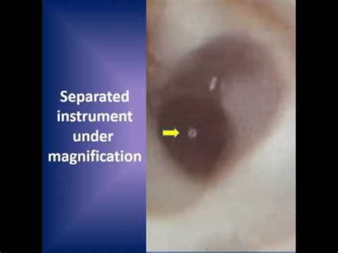 Bypassing A Separated Instrument In A Root Canal YouTube