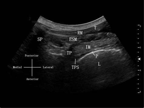 Ultrasound Image Of The Thoracic Paravertebral Block Tpvb Tps