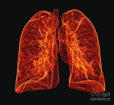 Healthy Lungs Photograph By Zephyrscience Photo Library Fine Art America