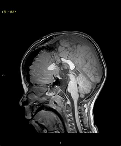 Post Operative Sagittal Mri Of Case 1 Download Scientific Diagram