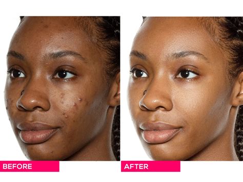 Professional Skin Retouching Done In Photoshop Upwork