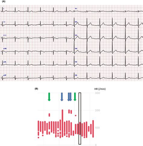 A Baseline Electrocardiogram Ecg B Hr Trend Recordings From The