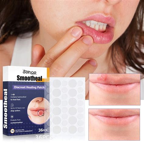 Weloille Cold Sore Smootheal Patches Cold Sore Discreet Healing Patch A Patch That Protects