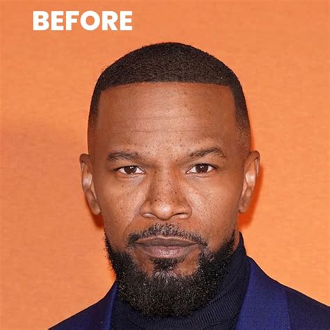 Jamie Foxx Hair Transplant Simulation