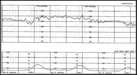 Example Of Fhr Top And Uterine Contraction Bottom During Labor Download Scientific Diagram