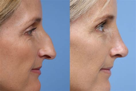 Types De Rhinoplastie Un Guide Complet