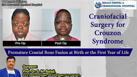 Craniofacial Surgery For Crouzon Syndrome Dr S M Balaji