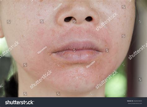 Photo De Stock Human Skin Presenting Allergic Reaction Allergic