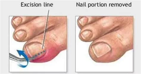 Ingrown Toenail Removal Before And After