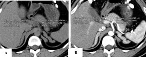 Computed Tomography Findings Of Testicular Adrenal Rest Tumors Resulted