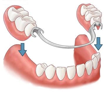 ¿Qué es una prótesis dental? Tipos de prótesis y usos - Gemeldent