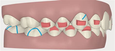 July 10th 2018 How To Set Up Inter Arch Elastics With Aligners For