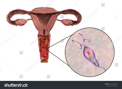 Female Trichomoniasis D Illustration Showing Vaginitis