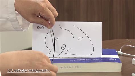 Af Ablation 2 Groin Puncture And Catheter Positioning Youtube