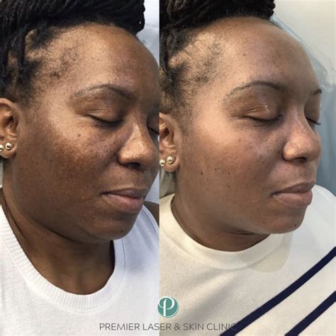 Cosmelan Peel London Premier Laser Skin Clinic