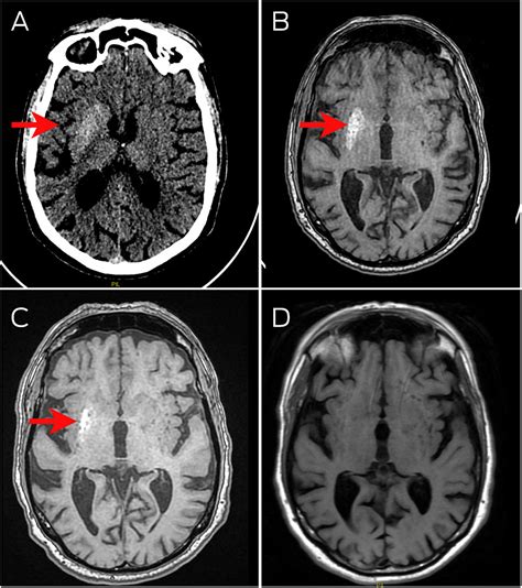 Hemichoreahemiballismus Due To Hyperglycaemia The Medical Journal Of