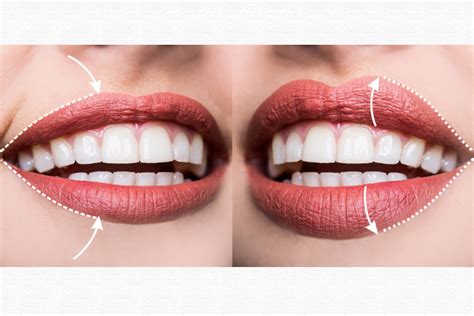 Botox Lip Flip Vs. Filler: Which One To Choose?