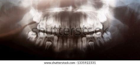 79 Imagens Fotos Stock Objetos 3d E Vetores De Baby Teeth Xray