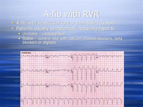 Ppt Cardiac Arrhythmias Powerpoint Presentation Id6165641