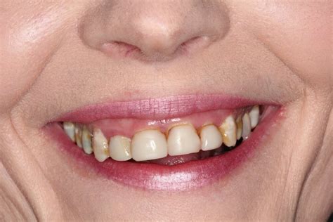 Laser Gum Treatment Before & After Gallery| StarImage Dentistry