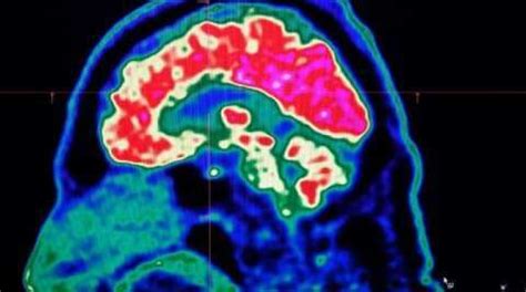 Not sleeping enough? Your brain might be eating itself - Science News