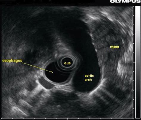 Endoscopic Ultrasound Eus